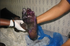 home-of-life-foundation-leg-ulcer-care-image1