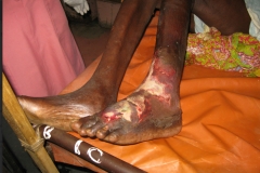 home-of-life-foundation-leg-ulcer-care-image2